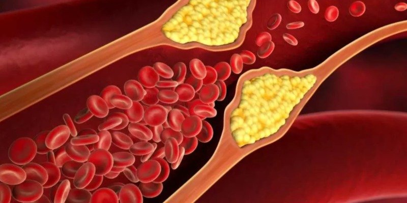 Triglicerídeos elevados